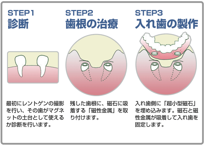マグネット入れ歯 - 大草歯科医院 八王子市 京王線 北野駅前 徒歩１分